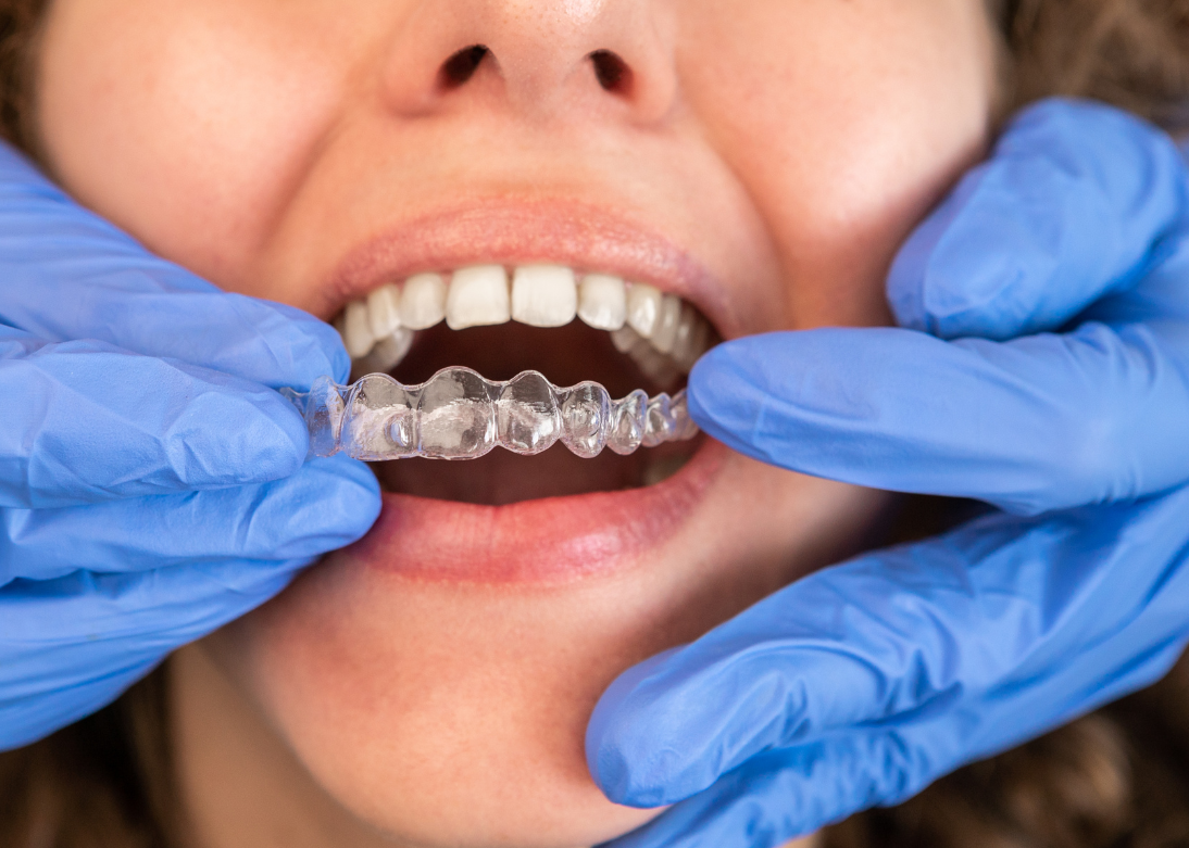 Invisalign Clear Aligners